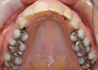 cerec after klim200.jpg